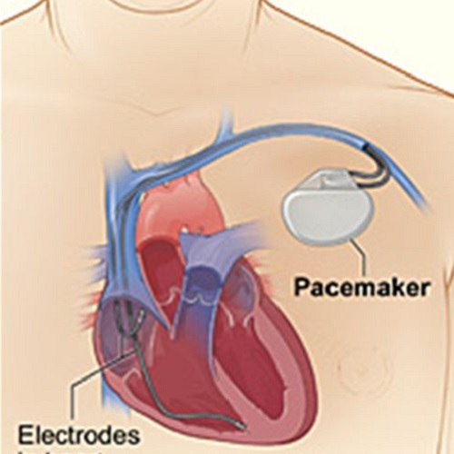 Tens Pacemaker Použití TENS při implantovaném KARDIOSTIMULÁTORU | painGURU